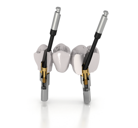 Dentium® Implantium® Superline® compatible TPA Screw for angled screw channels
